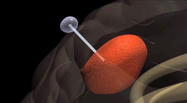 Раковые клетки головного мозга будут ловить на «удочку» - «Технологии»
